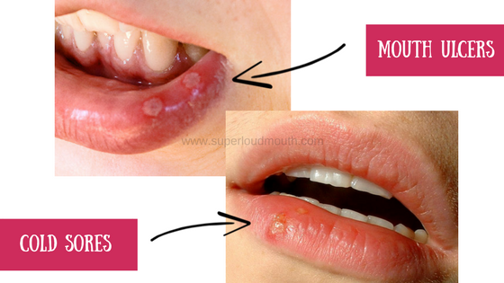 how to cure mouth ulcers