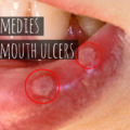 home remedies to remove mouth ulcers