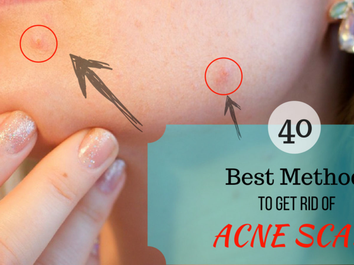 40 Best Ways To Get Rid Of Acne Scabs Overnight Diy Home Remedies get rid of acne scabs overnight