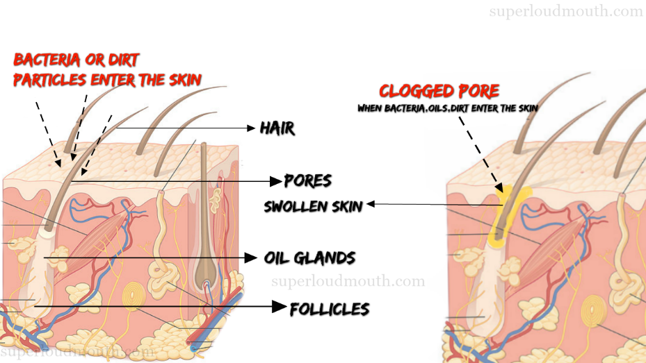 causes of acne scab