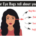 what your eye bags tell about your health