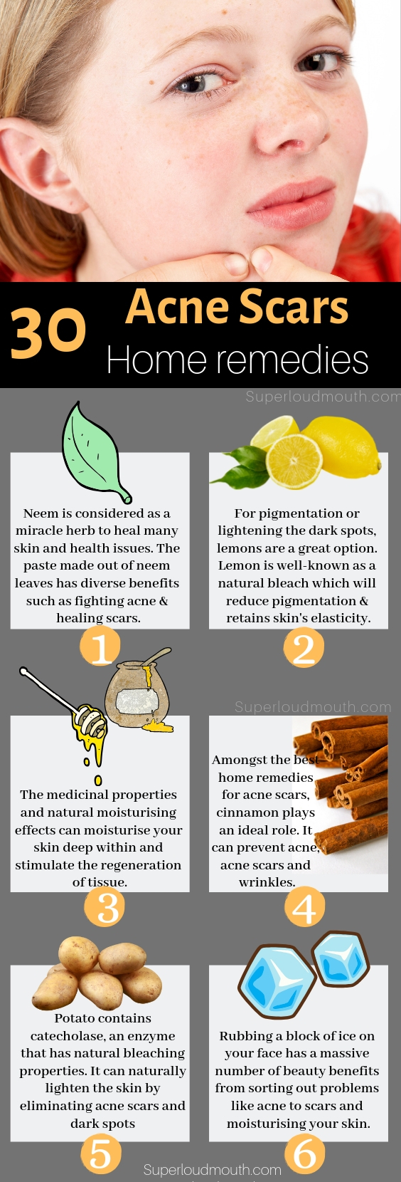 30 Natural Home Remedies to heal Acne Scars overnight