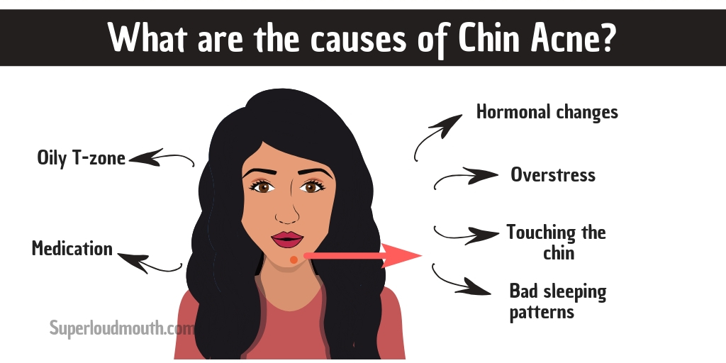 What are the causes of Chin Acne_