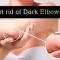 how to get rid of dark elbows and knees