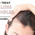 How to treat hair loss on temples