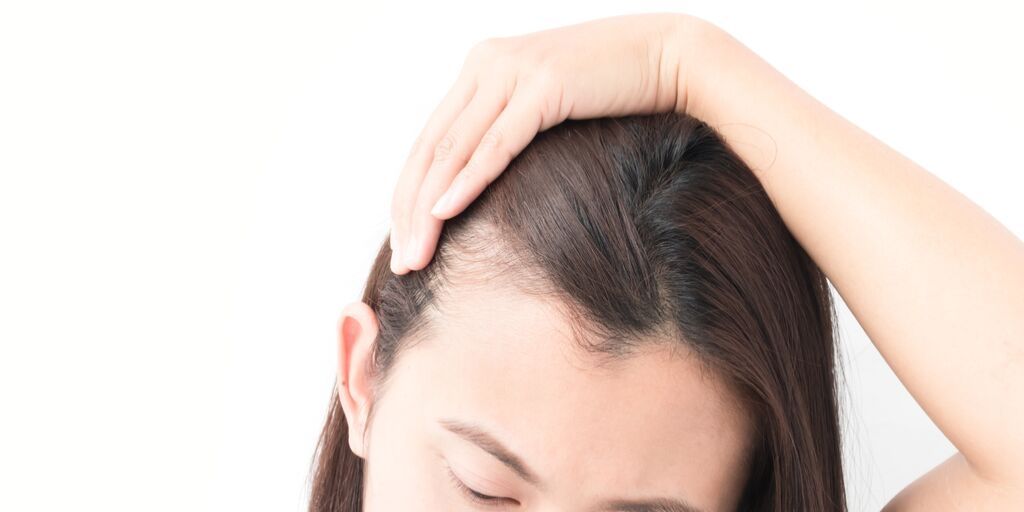 temple hair loss