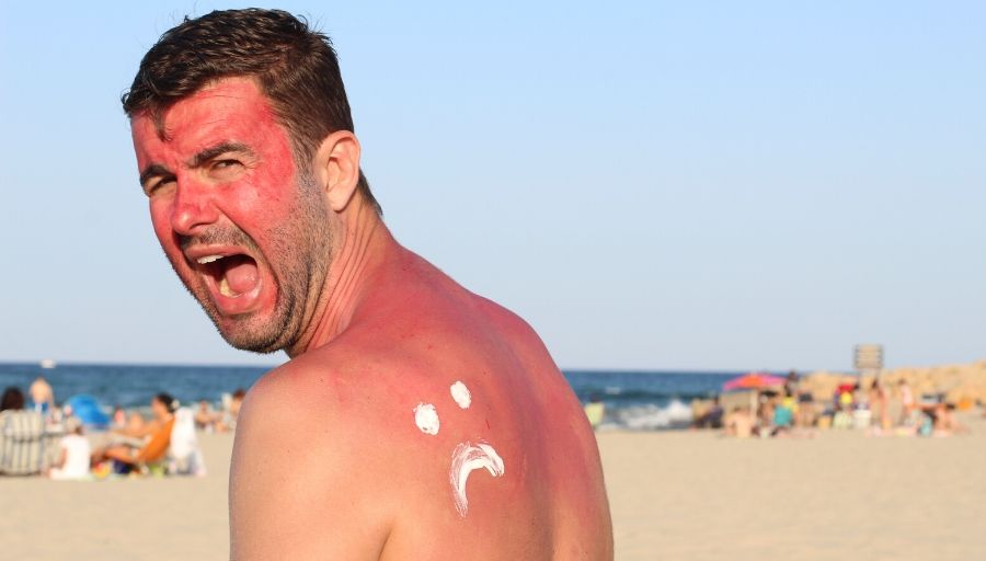 how to prevent sunburn
