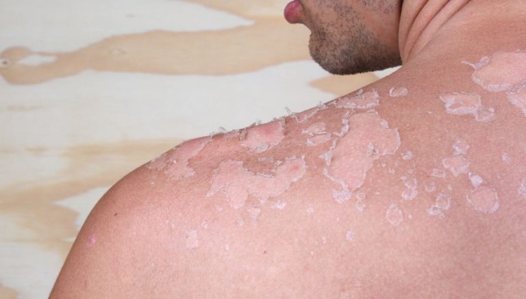 How To Get Rid Of Sunburns Fast With Home Remedies And Treatments