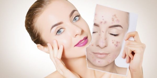 how to get rid of acne naturally