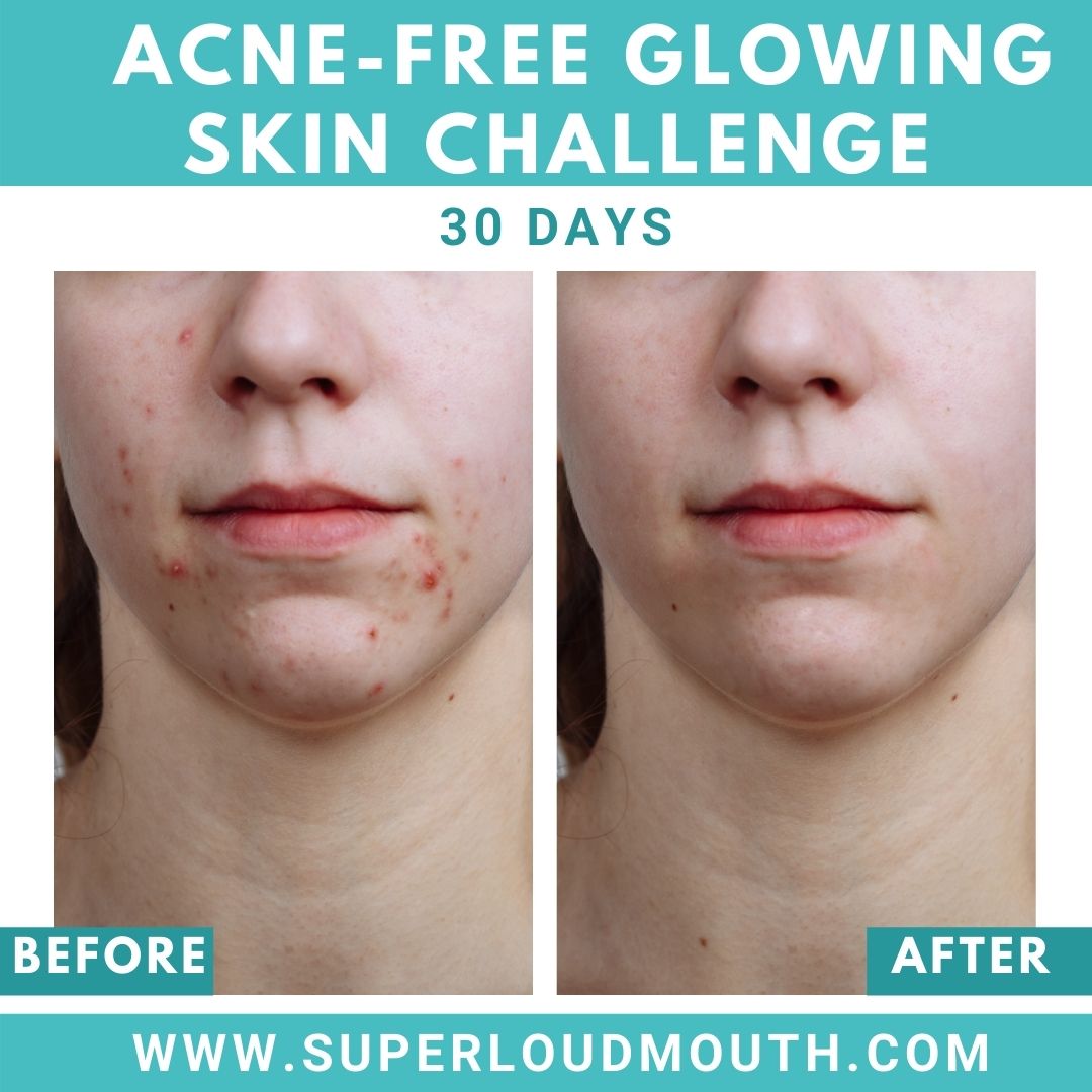 acne cure challenge ad poster 3