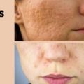 treatments to get rid of acne scars