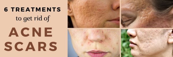 treatments to get rid of acne scars
