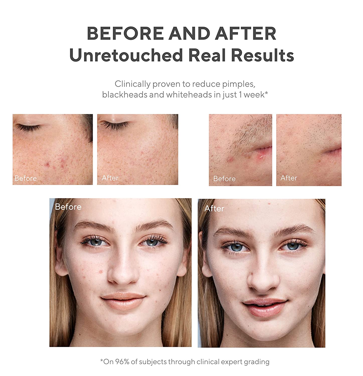 murad outsmart acne clarifying treatment review